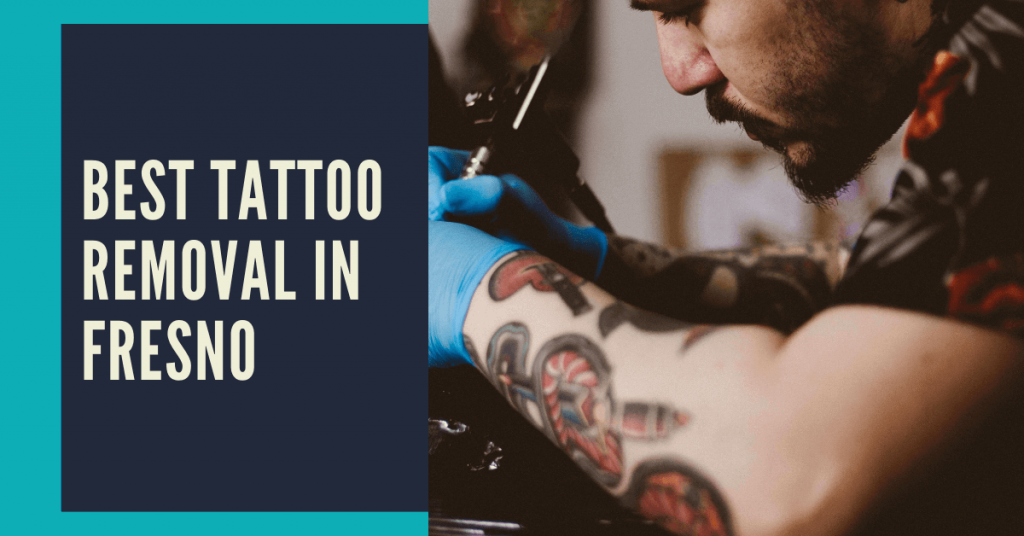 Best Tattoo Removal in Fresno